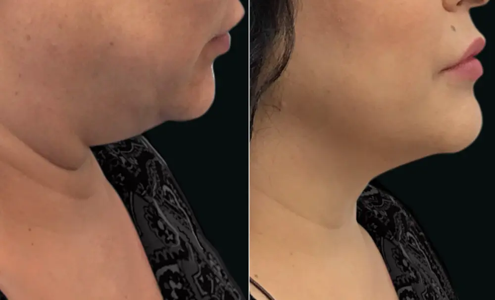 Renuvion Before and After 3