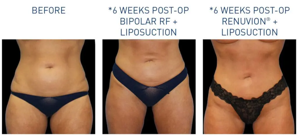 Renuvion Before and After 4