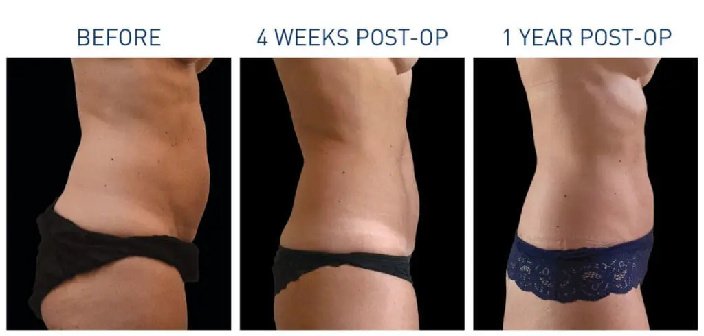 Renuvion Before and After 5