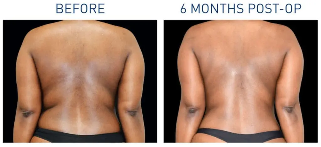 Renuvion Before and After 6