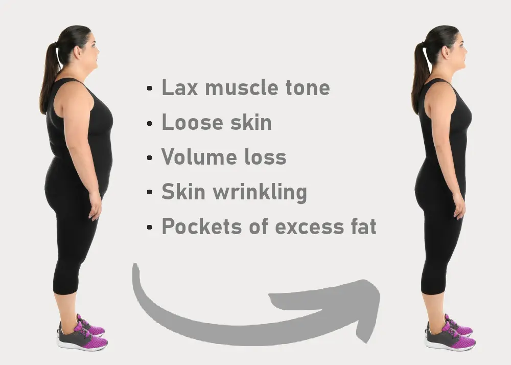 post weight loss treatments