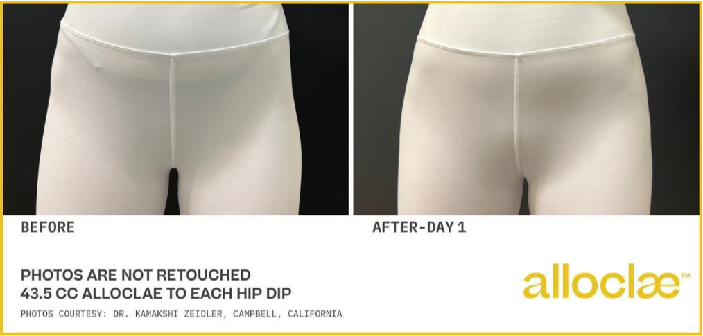 alloclae before and after images -1