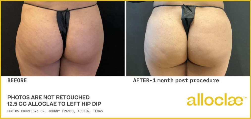 alloclae before and after images -2