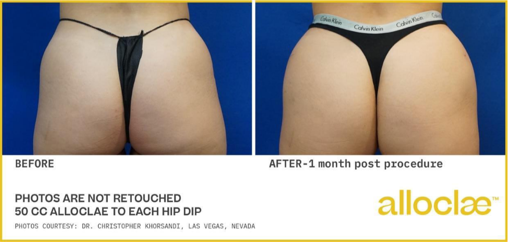 alloclae before and after images -3