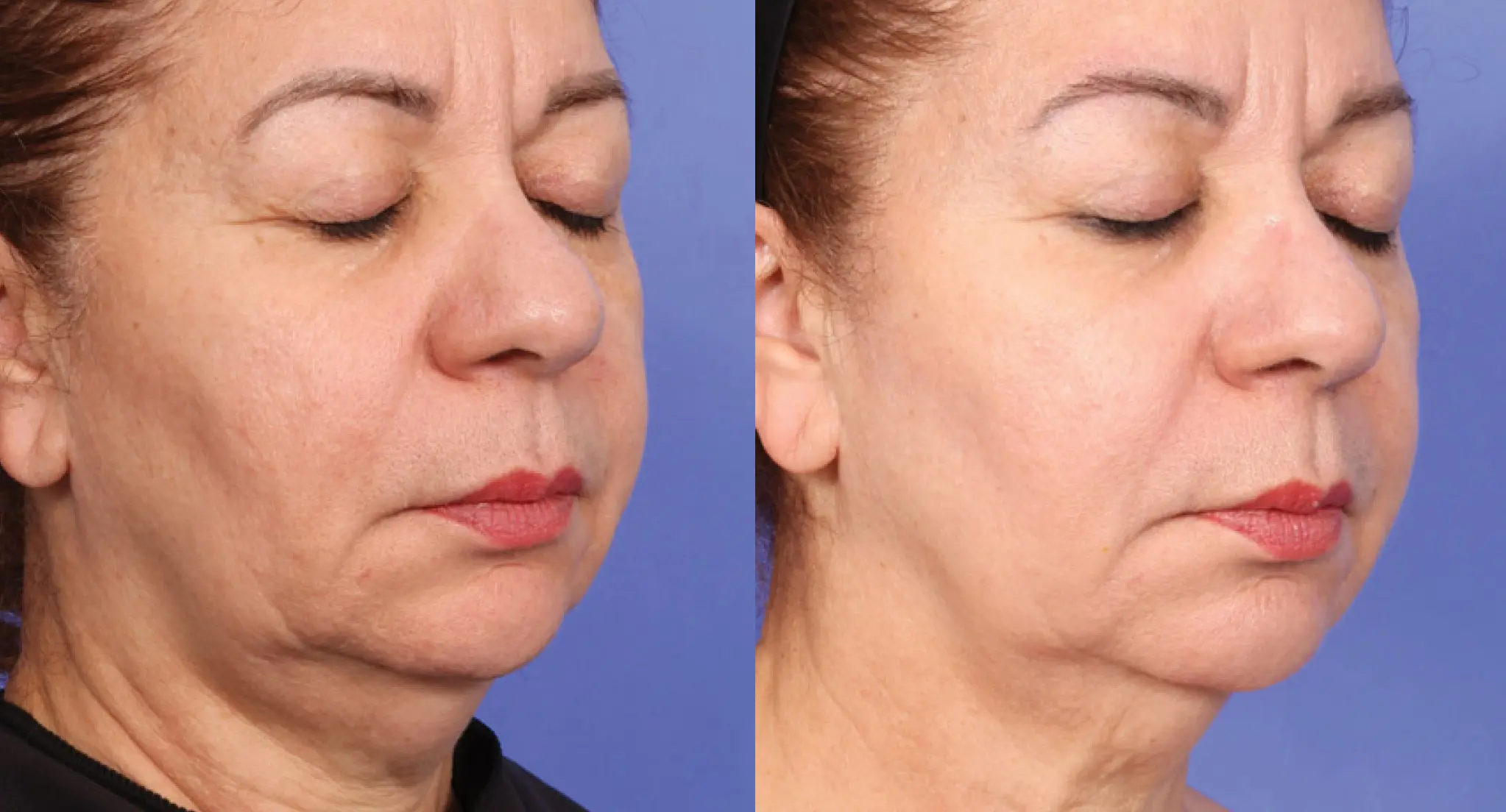 XERF real patient before and after 1