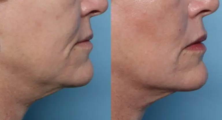XERF real patient before and after 10
