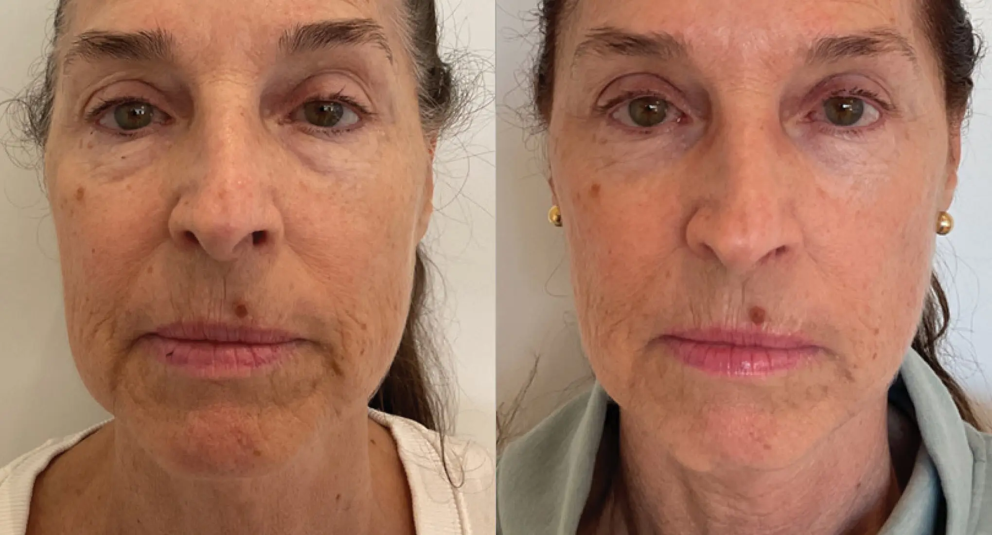 XERF real patient before and after 2