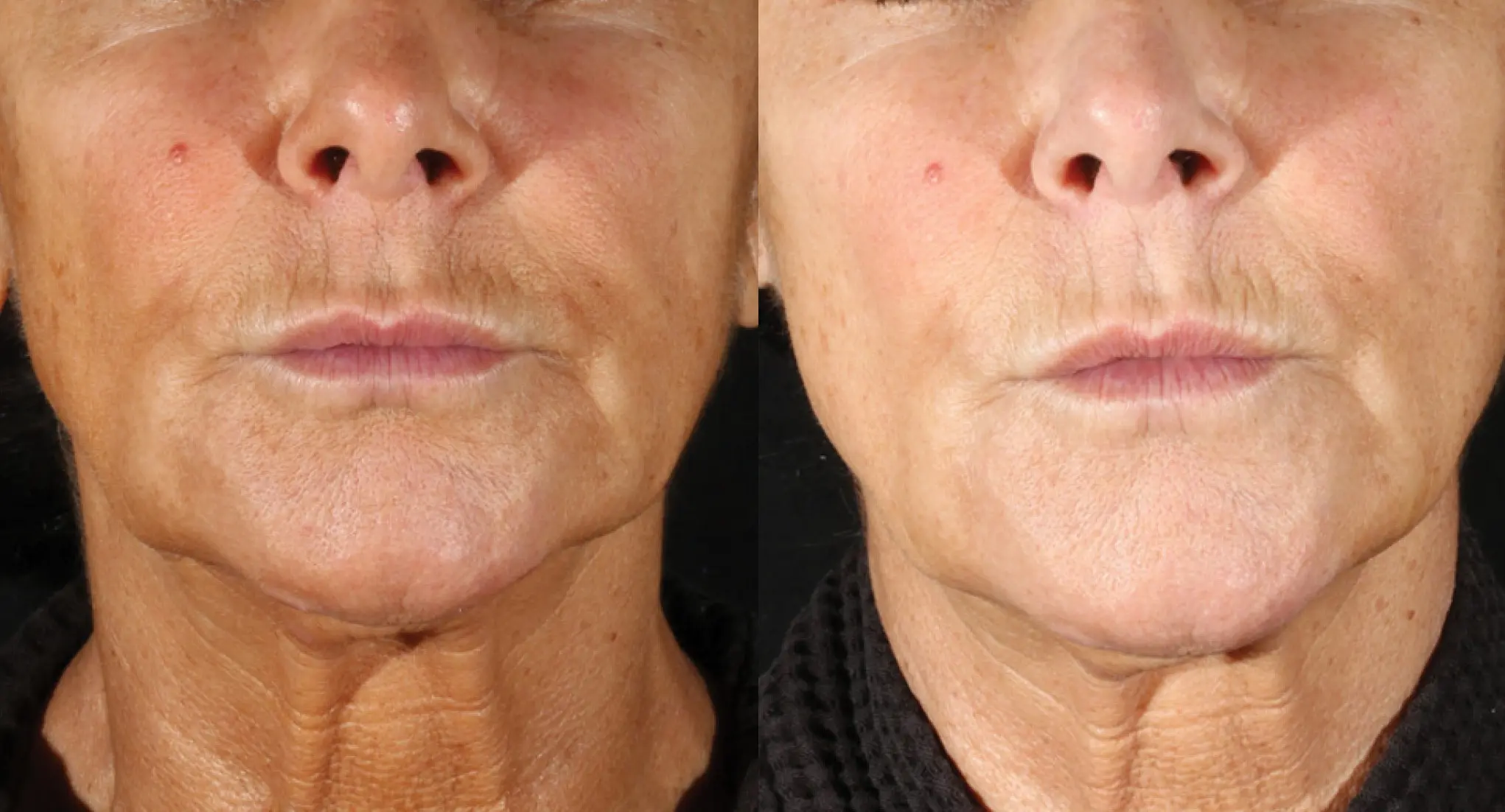 XERF real patient before and after 3