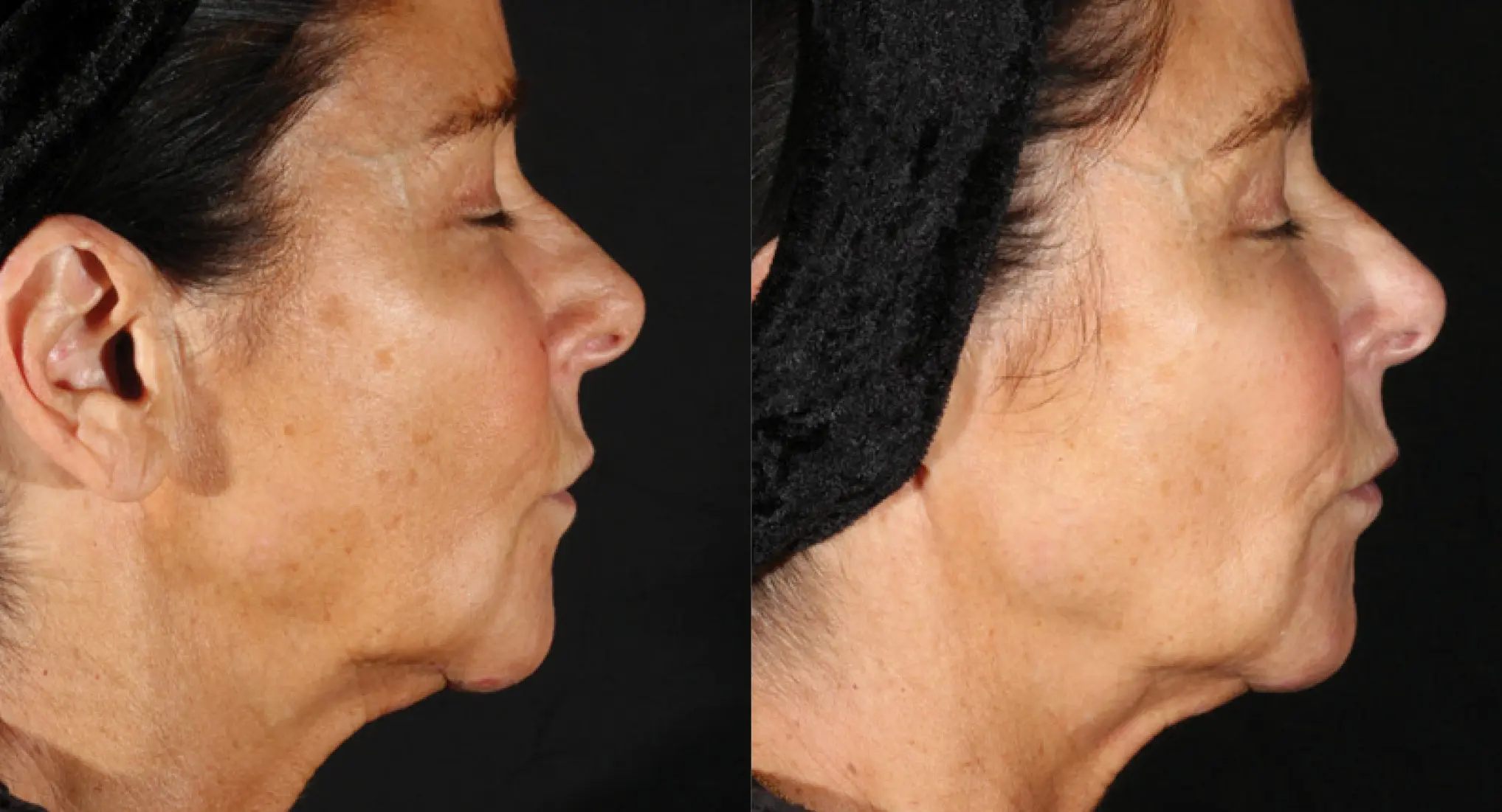 XERF real patient before and after 4