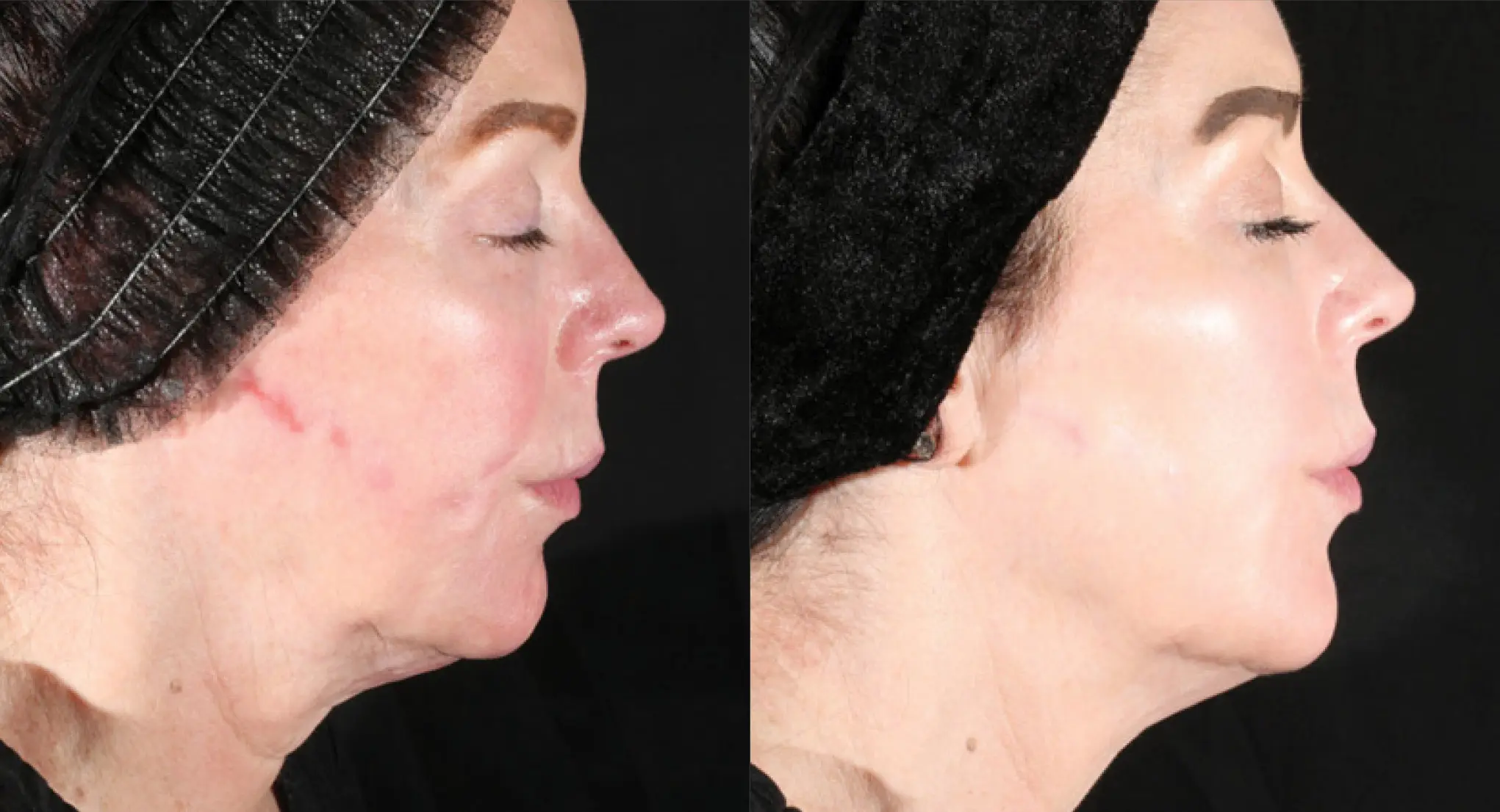 XERF real patient before and after 5