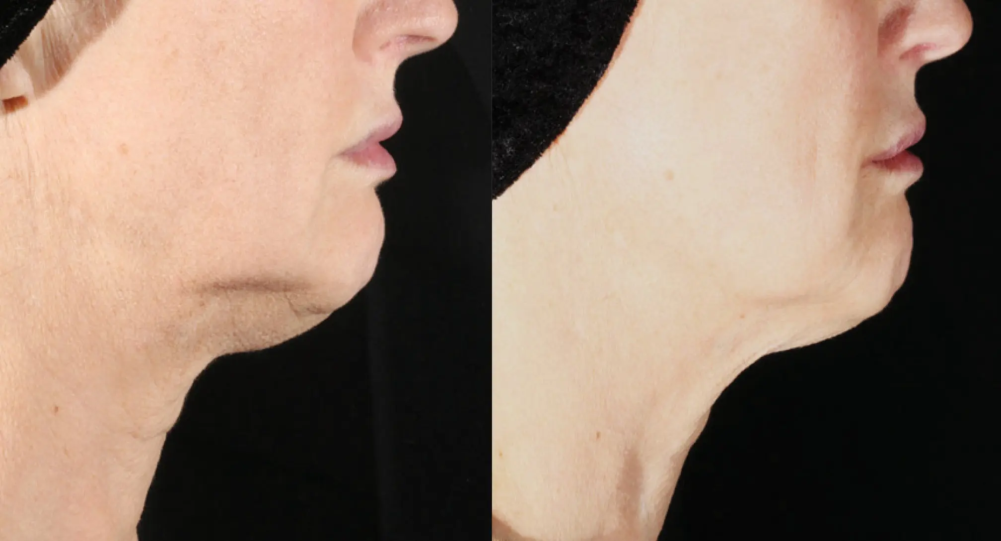 XERF real patient before and after 6