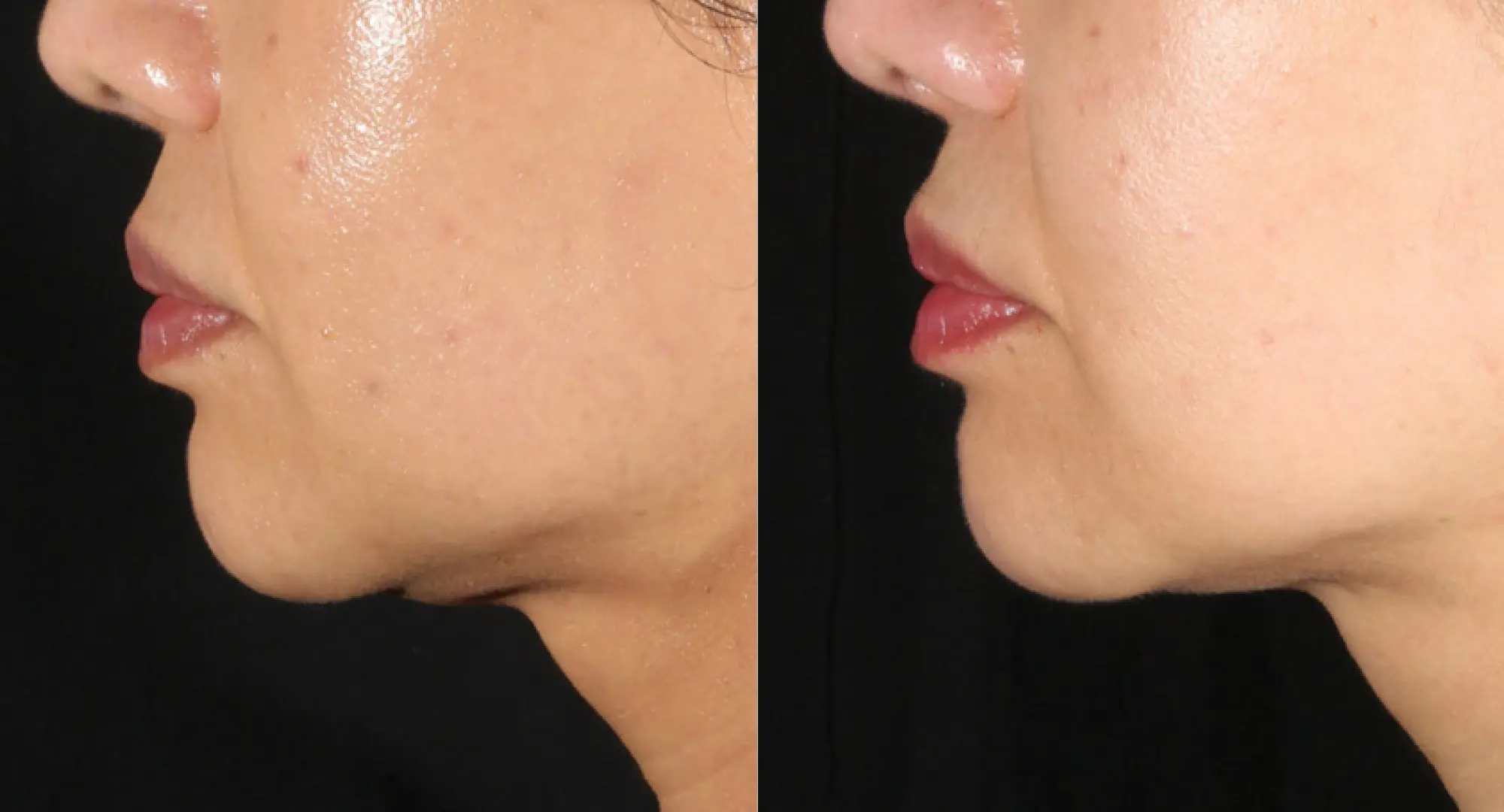 XERF real patient before and after 8
