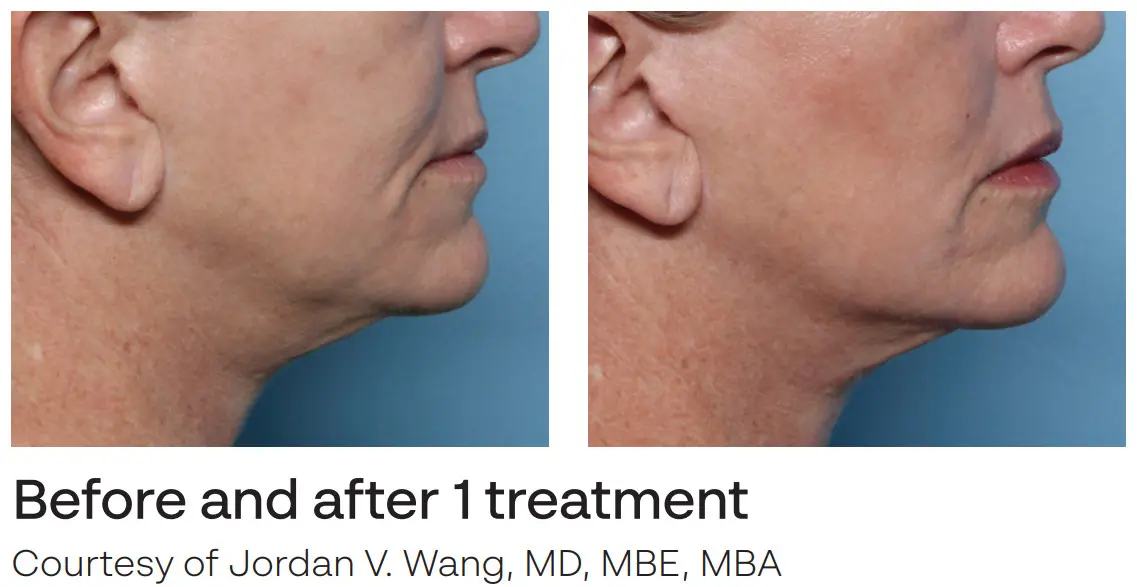 xerf before and after 2
