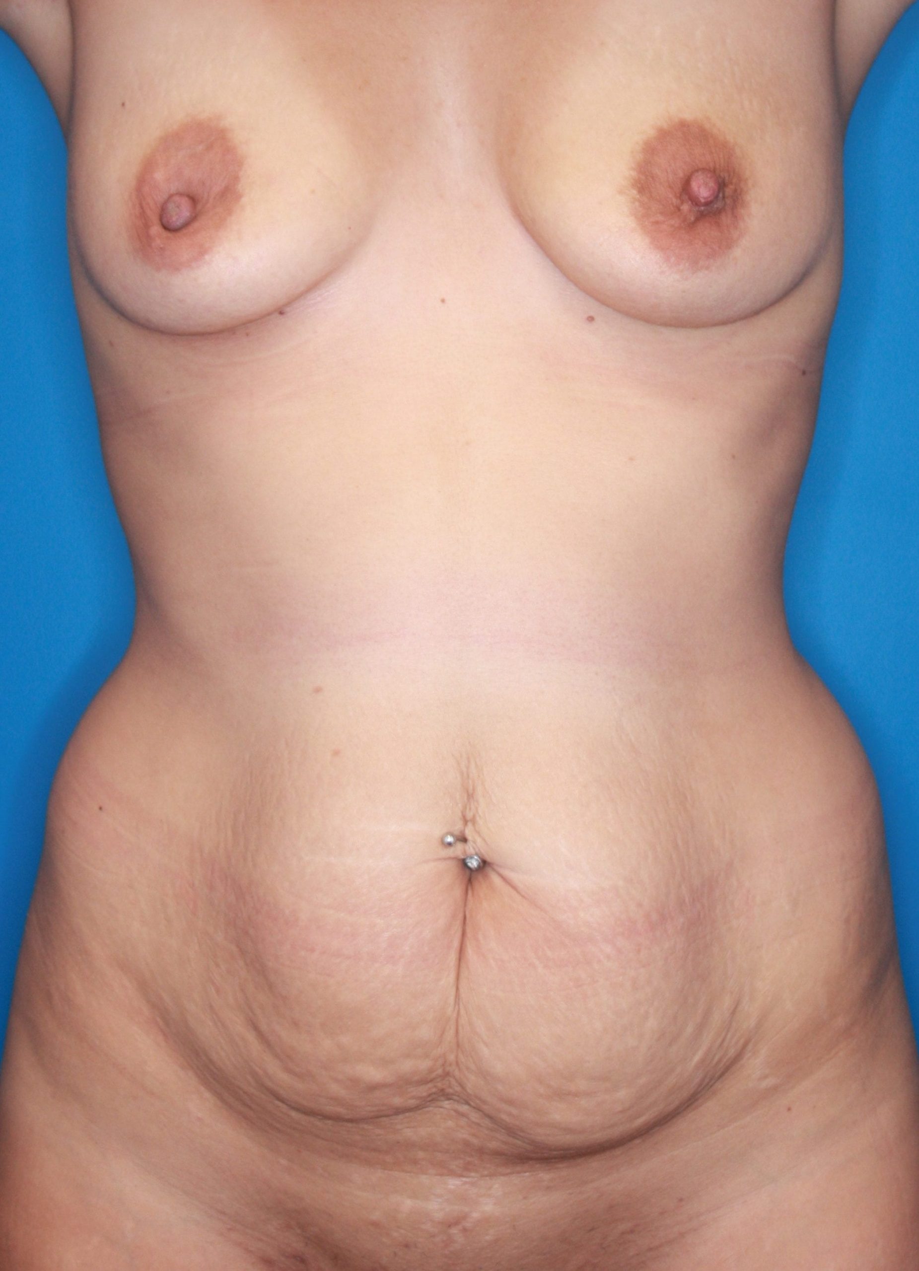 Mommy Makeover Patient Photo - Case 150 - before view-