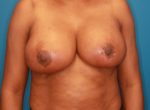 Breast Reduction - Case 143 - After