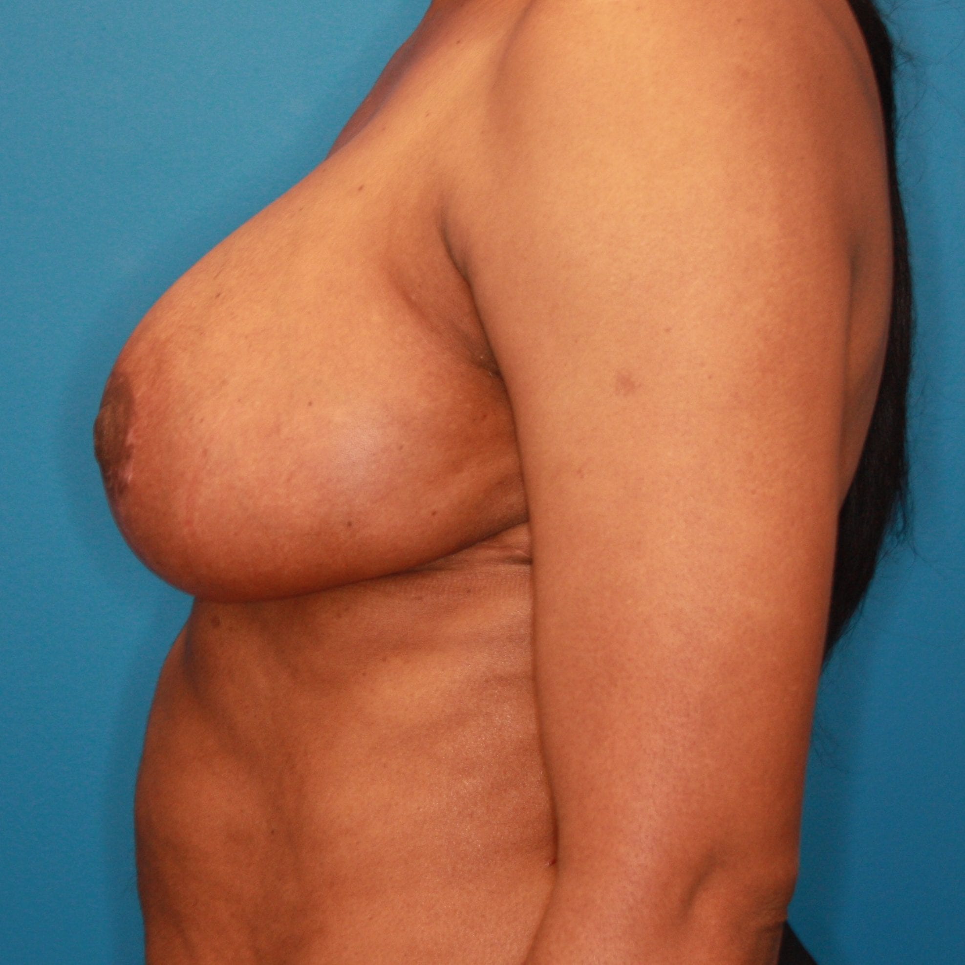 Breast Reduction Patient Photo - Case 143 - after view-2