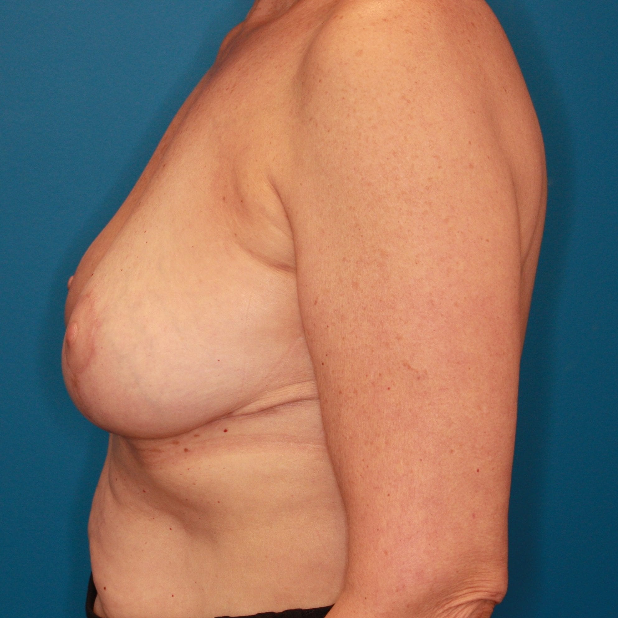Breast Reduction Patient Photo - Case 142 - after view-2