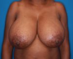 Breast Reduction - Case 143 - Before