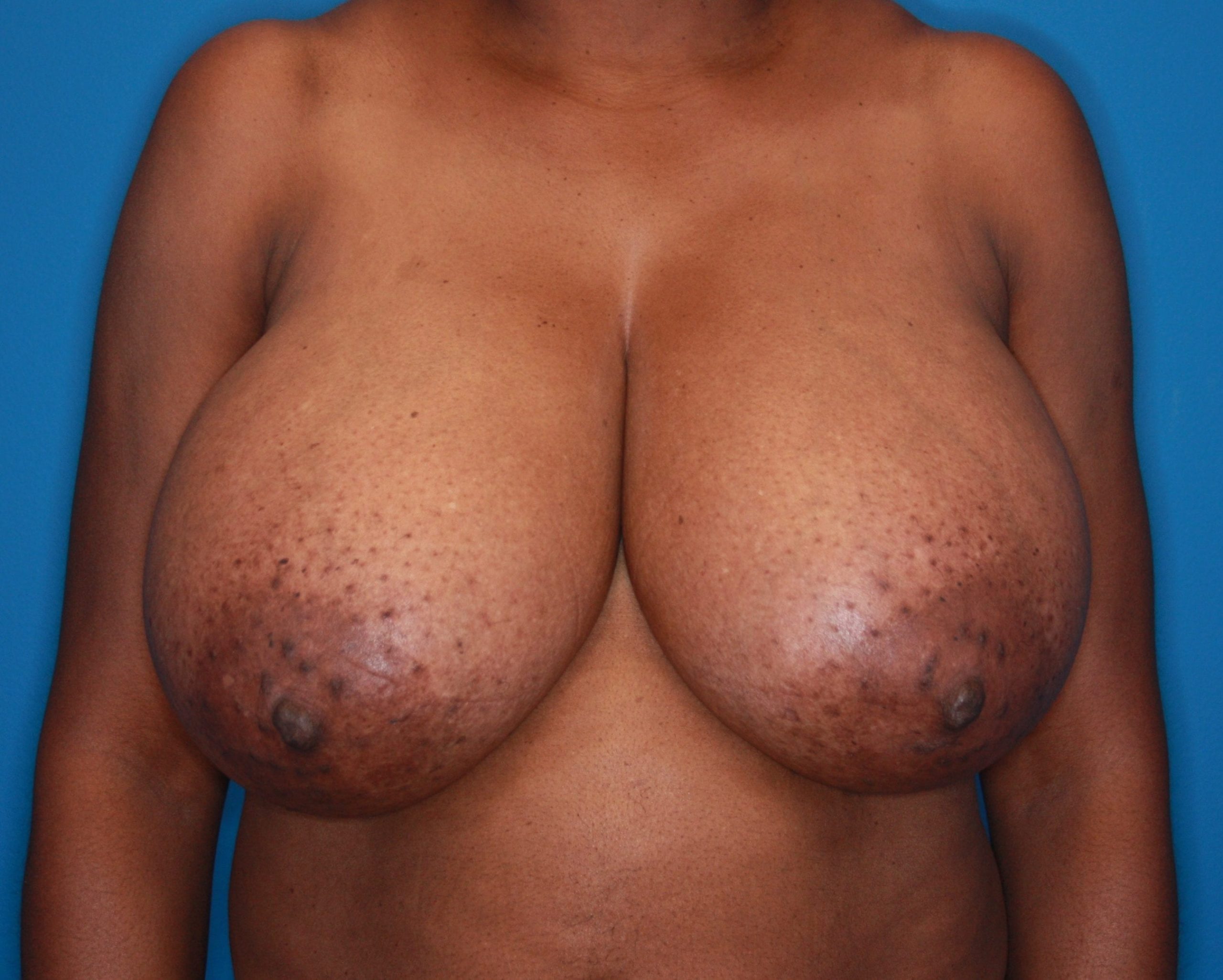 Breast Reduction Patient Photo - Case 143 - before view-0