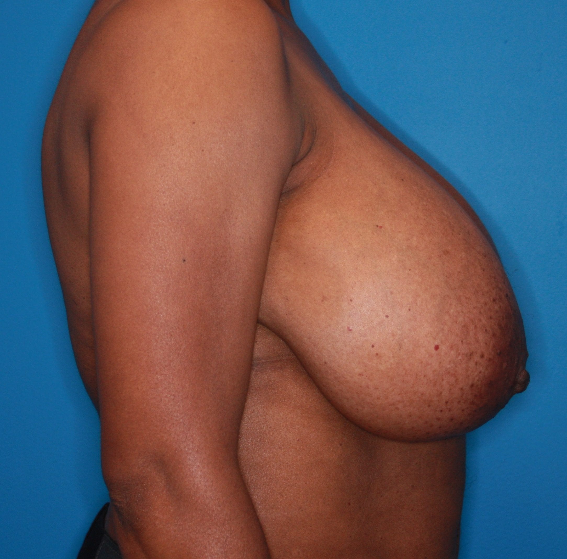 Breast Reduction Patient Photo - Case 143 - before view-3