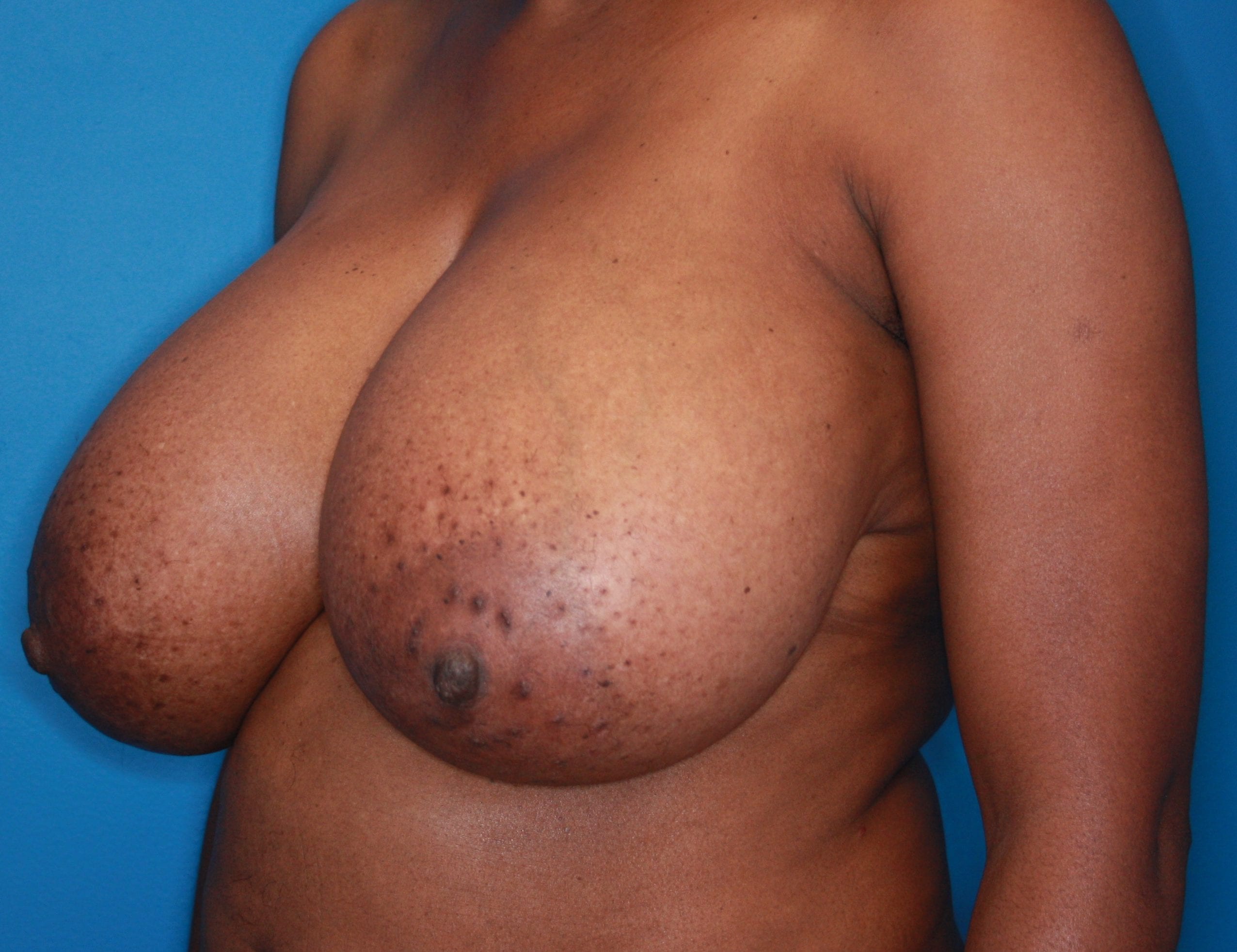 Breast Reduction Patient Photo - Case 143 - before view-1