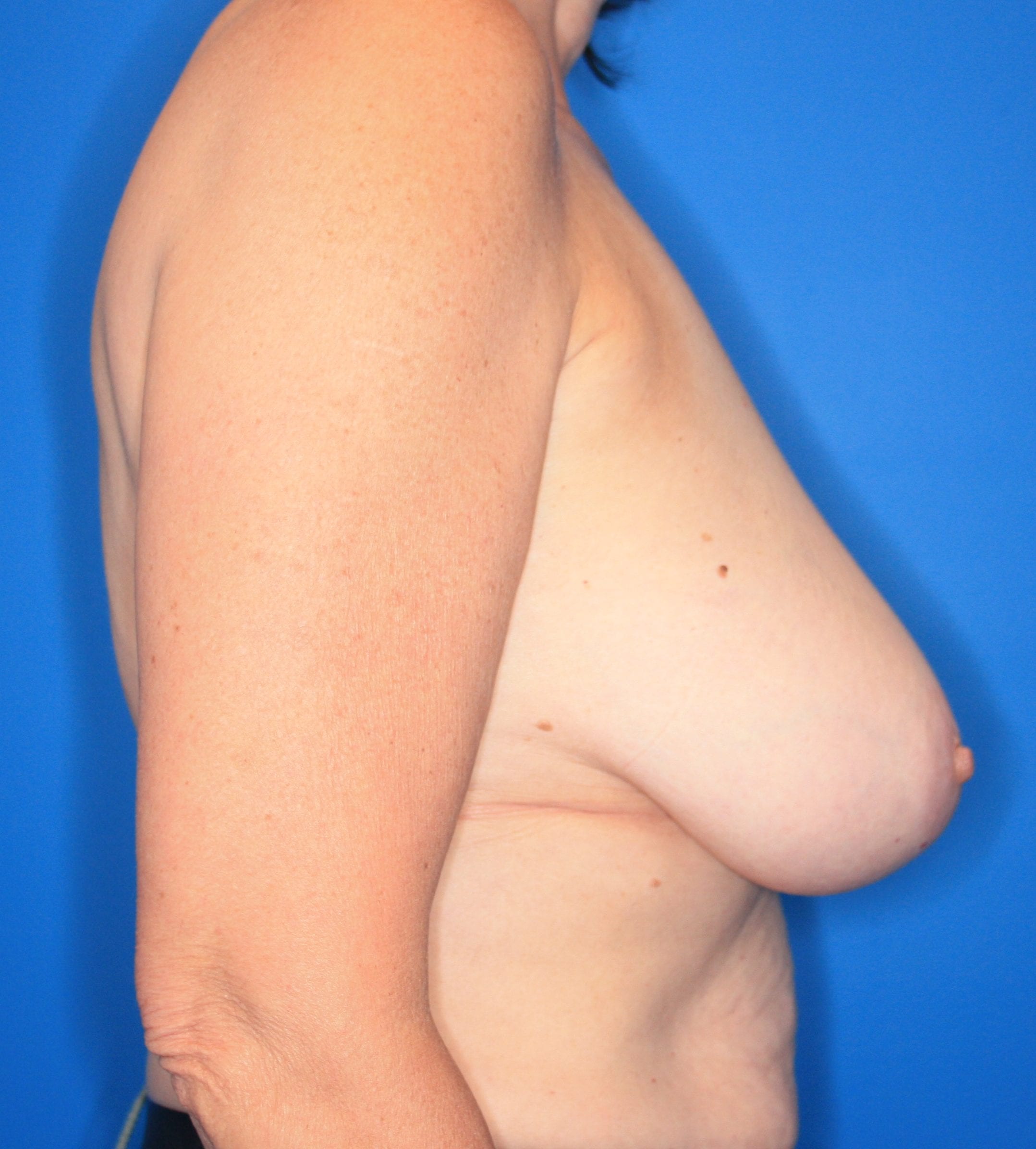 Breast Reduction Patient Photo - Case 142 - before view-4
