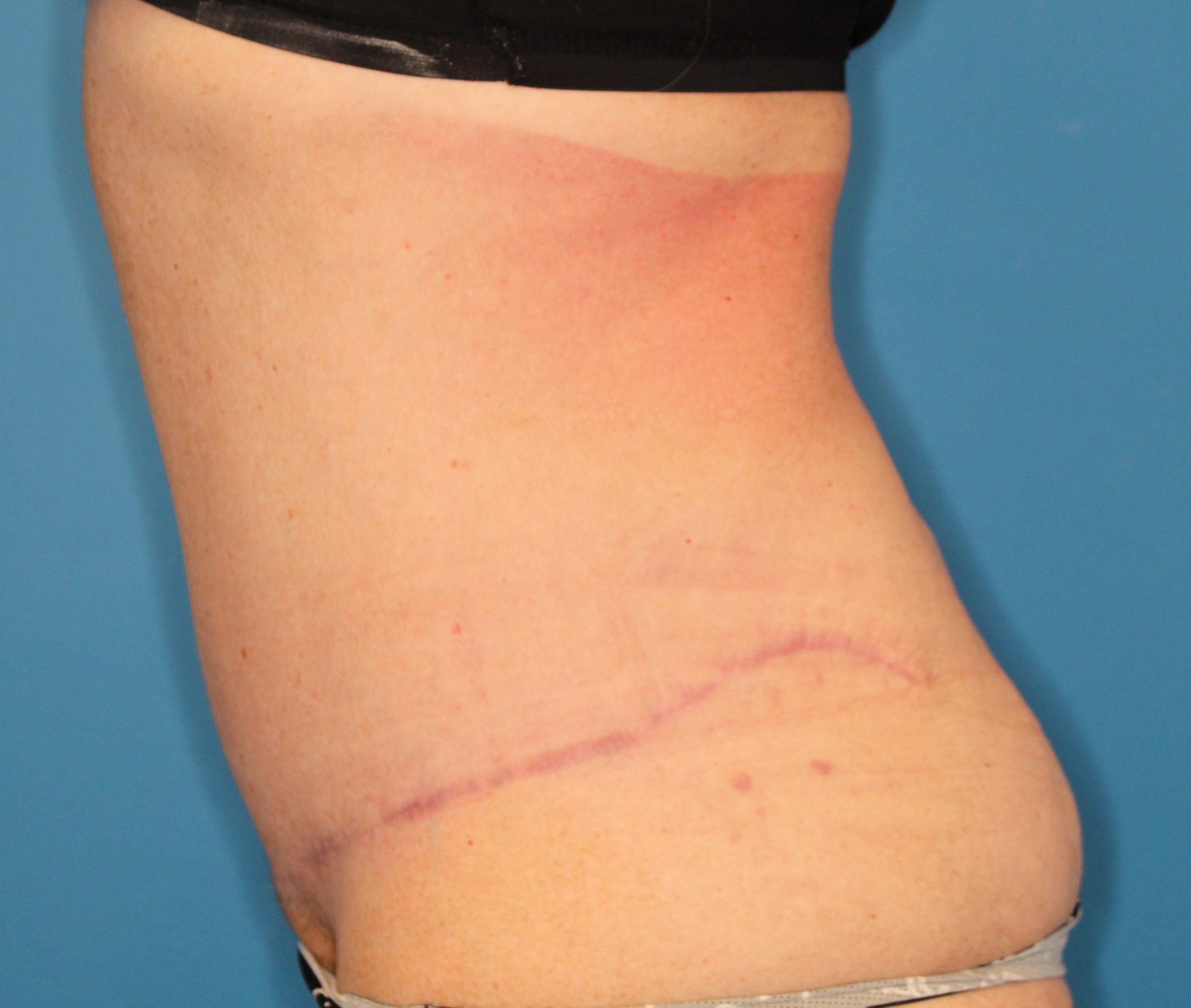 Tummy Tuck Patient Photo - Case 151 - after view-1