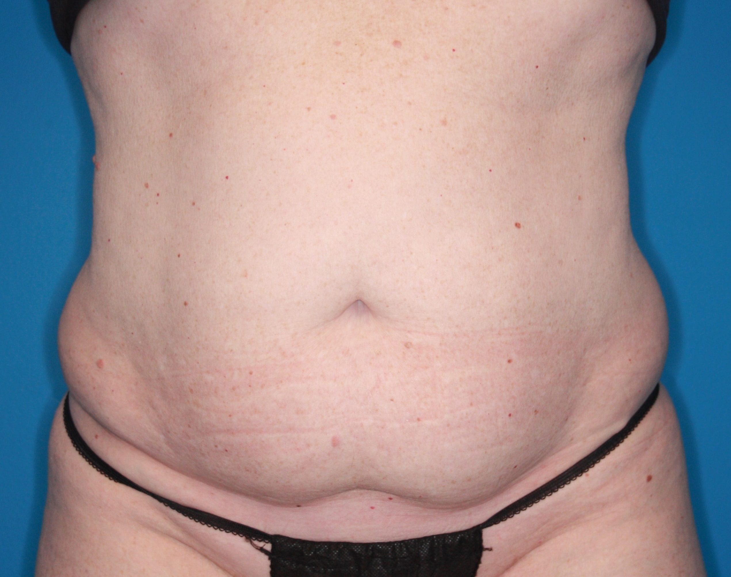 Tummy Tuck Patient Photo - Case 151 - before view-0