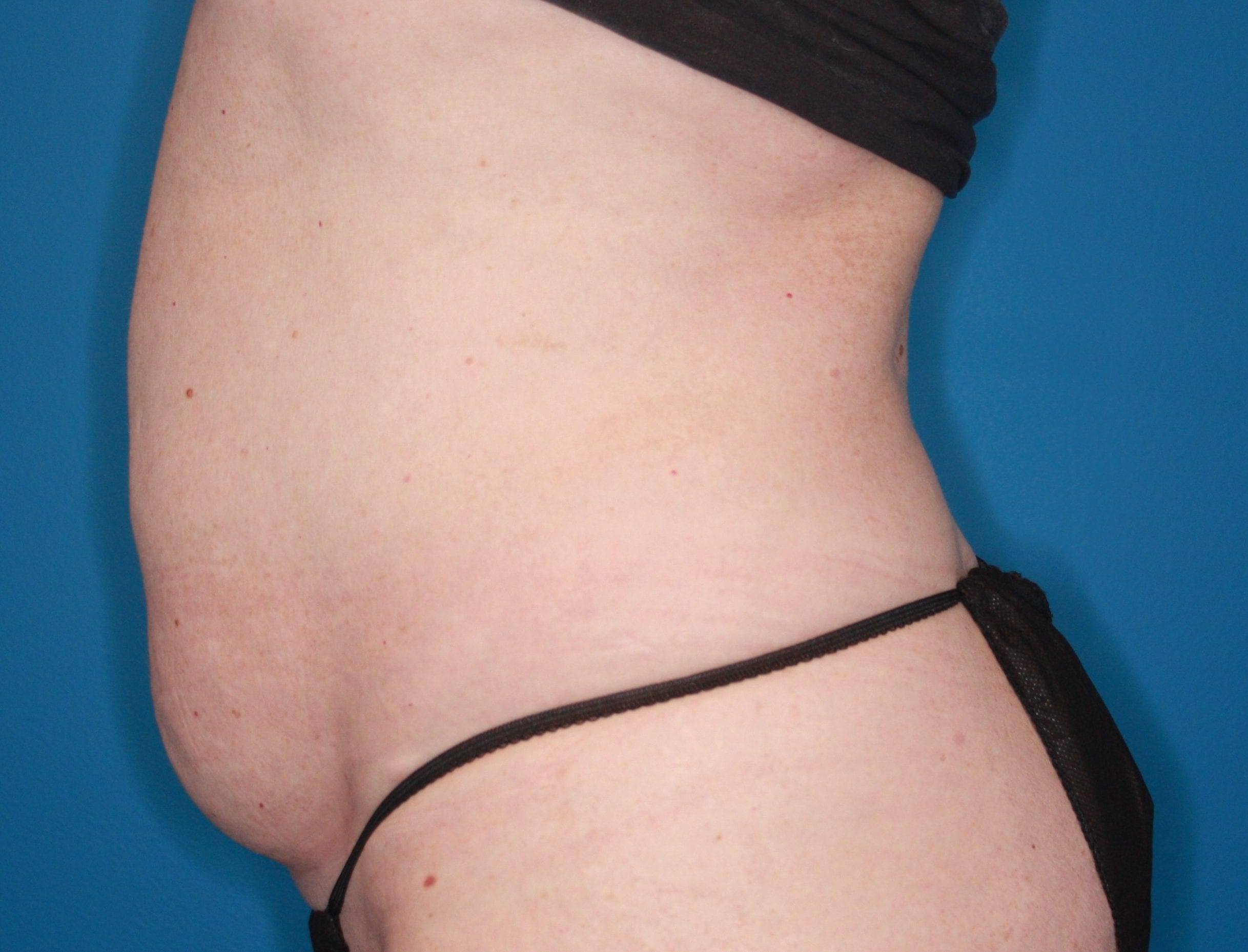 Tummy Tuck Patient Photo - Case 151 - before view-1