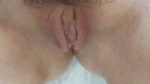 Labiaplasty - Case 153 - After