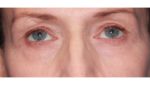 Eyelid Surgery - Case 160 - Before