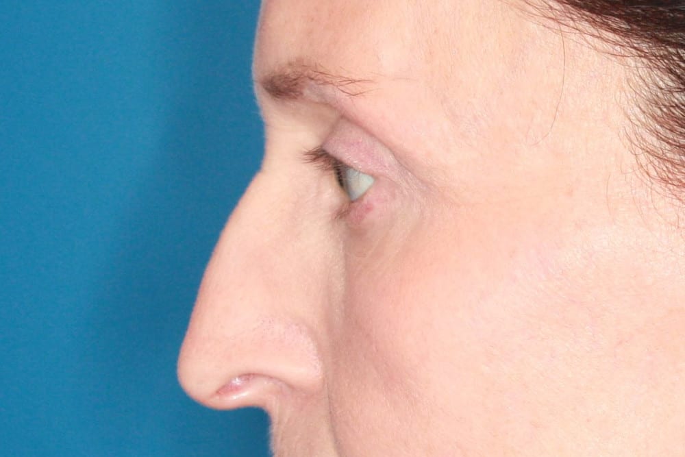 Eyelid Surgery Patient Photo - Case 160 - after view-1