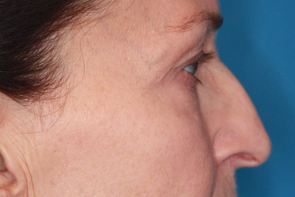 Eyelid Surgery Patient Photo - Case 160 - before view-2