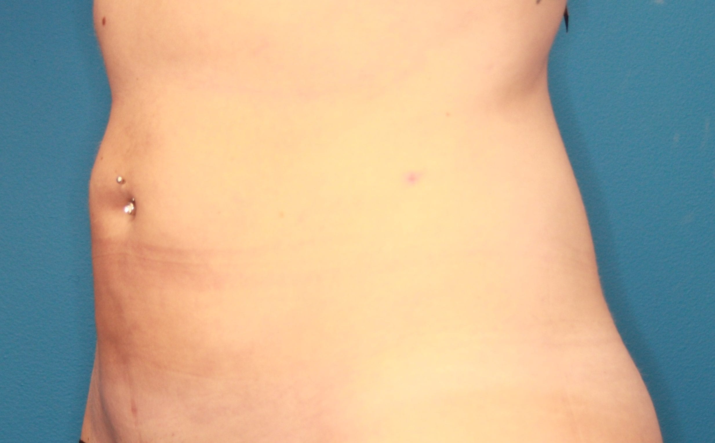 Liposuction Patient Photo - Case 155 - after view-1