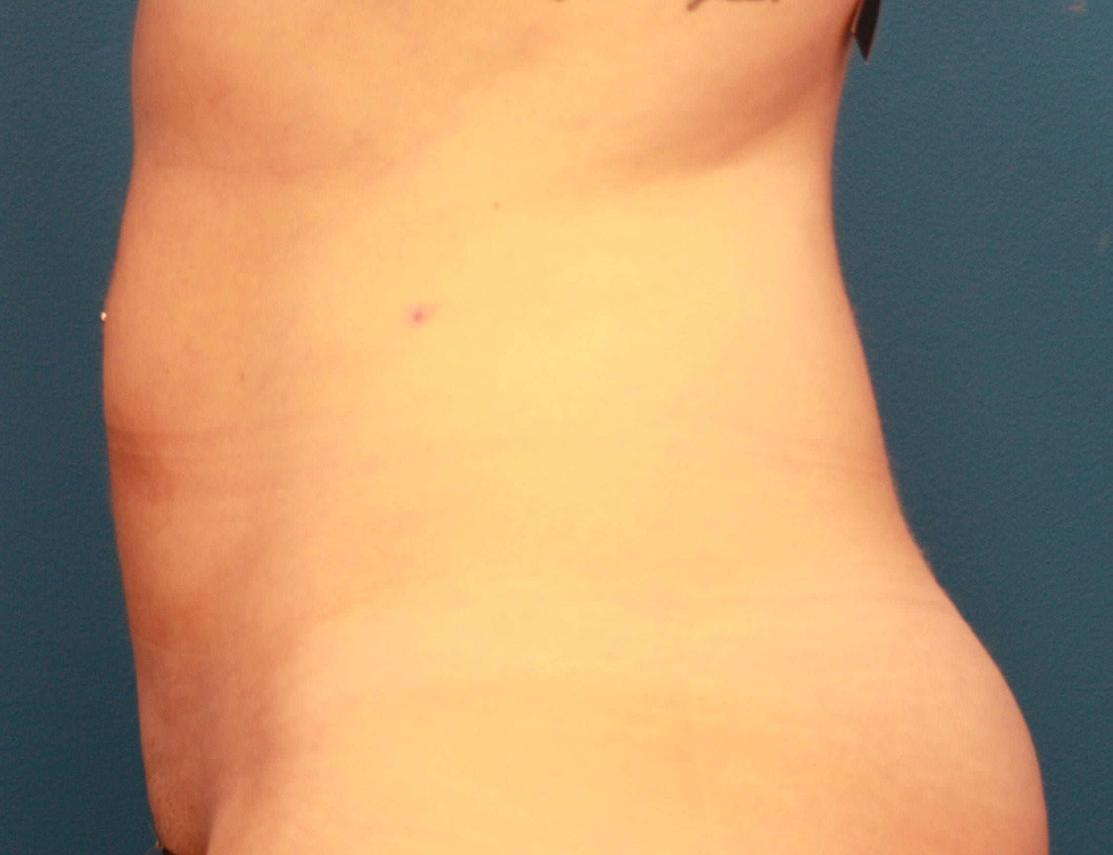 Liposuction Patient Photo - Case 155 - after view-2