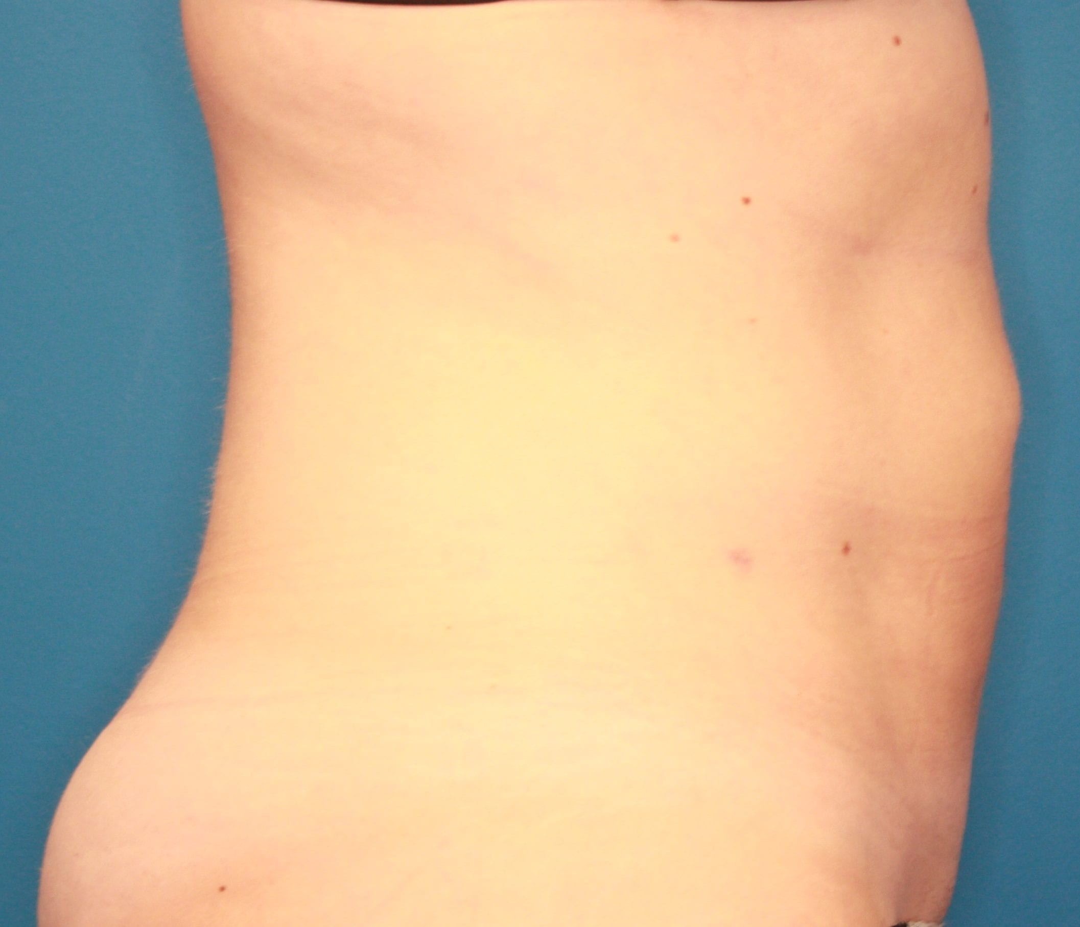 Liposuction Patient Photo - Case 155 - after view-4