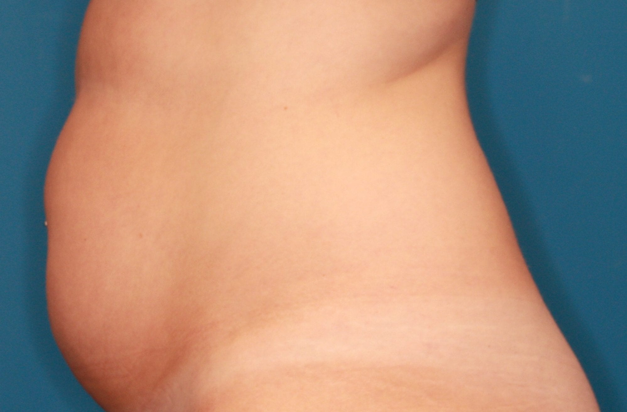 Liposuction Patient Photo - Case 155 - before view-2