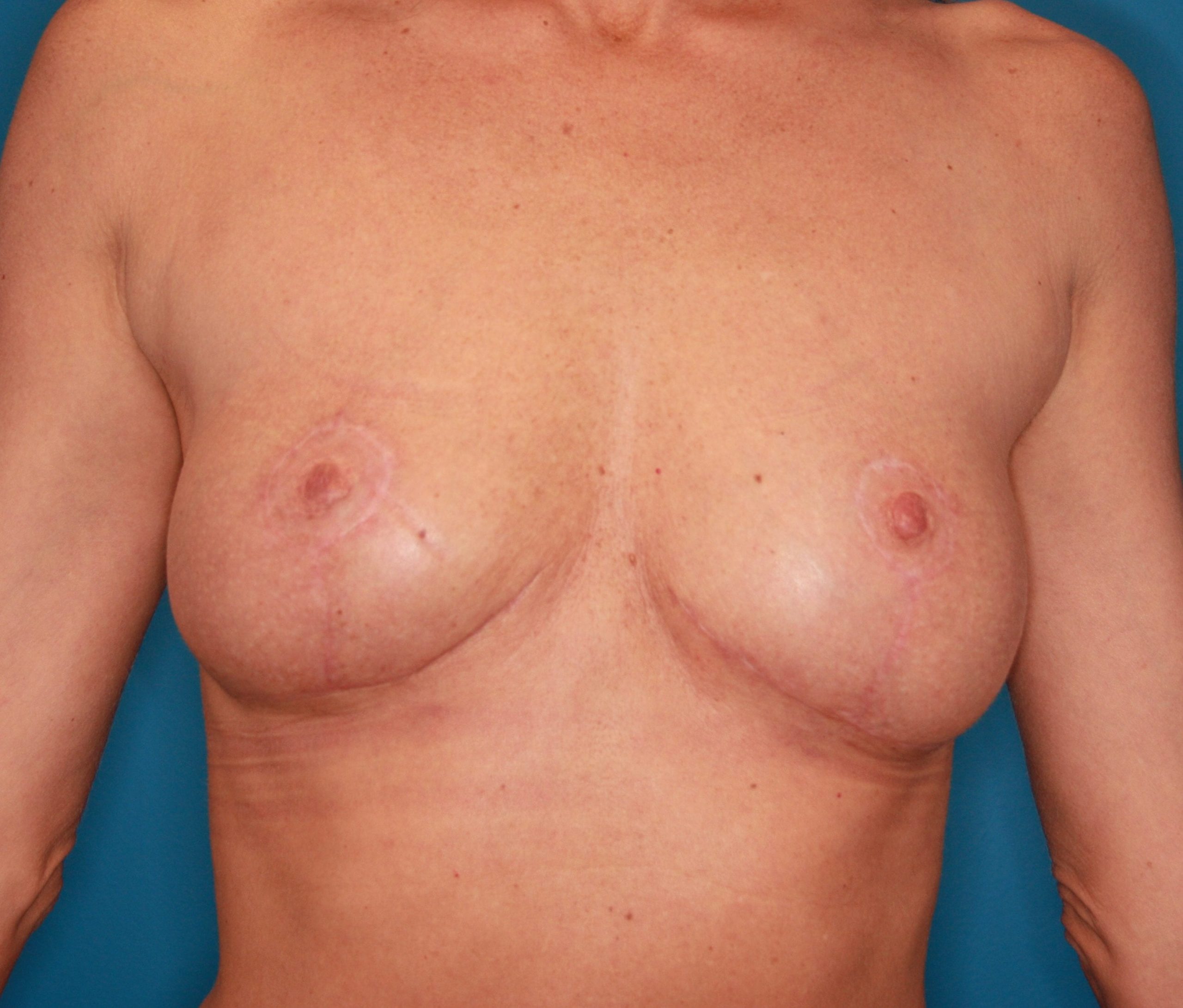 Breast Lift Patient Photo - Case 156 - after view