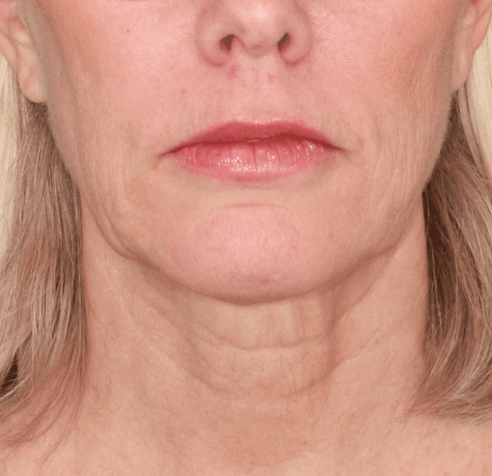 Profound RF Face Patient Photo - Case 157 - after view-0