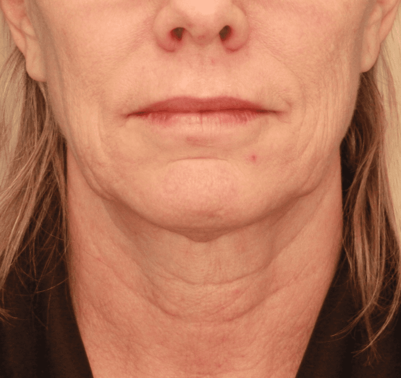 Profound RF Face Patient Photo - Case 157 - before view-0
