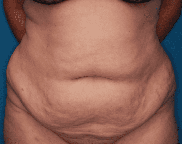 Tummy Tuck Patient Photo - Case 158 - before view-0