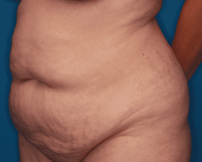 Tummy Tuck Patient Photo - Case 158 - before view-1