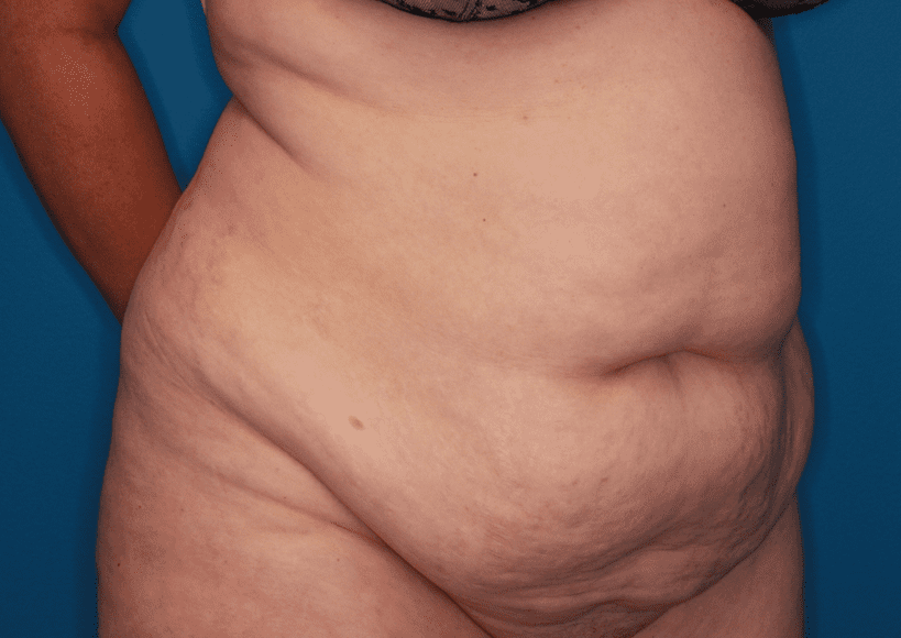Tummy Tuck Patient Photo - Case 158 - before view-3