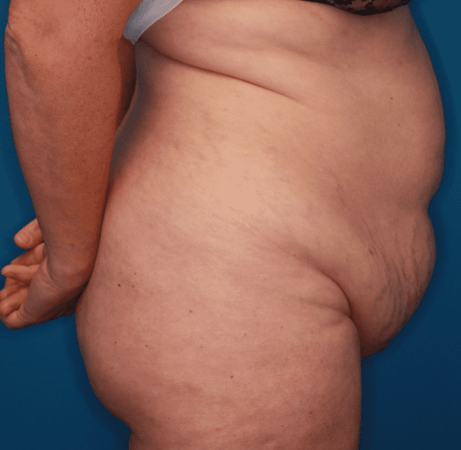 Tummy Tuck Patient Photo - Case 158 - before view-4