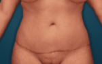 Tummy Tuck - Case 158 - After