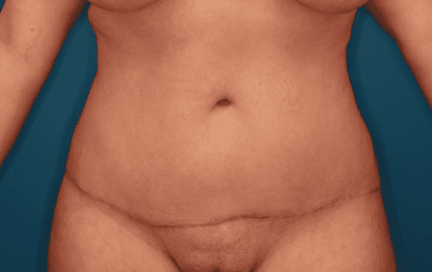 Tummy Tuck Patient Photo - Case 158 - after view