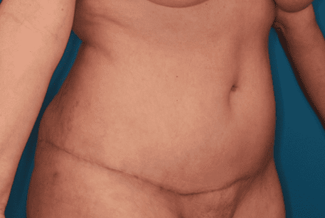 Tummy Tuck Patient Photo - Case 158 - after view-3