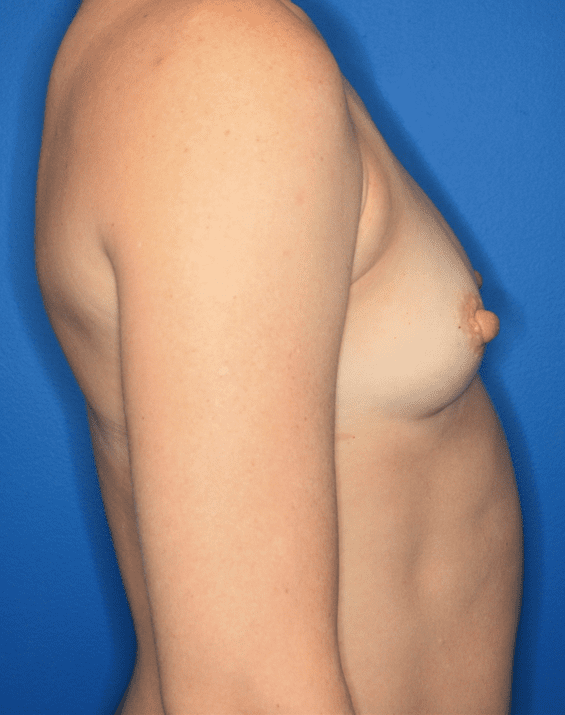 Breast Augmentation Patient Photo - Case 159 - before view-4