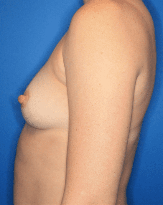 Breast Augmentation Patient Photo - Case 159 - before view-2