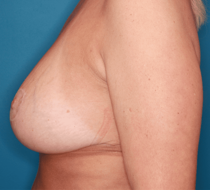 Breast Lift Patient Photo - Case 161 - after view-2